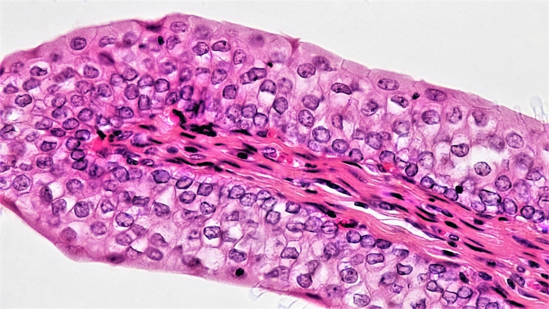 #IDH1-mutation symboliseret ved langstrakt rosa-lilla farvet celle på hvid baggrund.