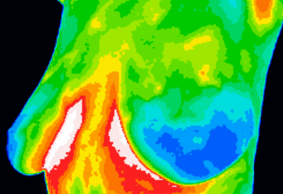 Termografi symboliseret ved termografisk billede af øvre del af torso - brystparti