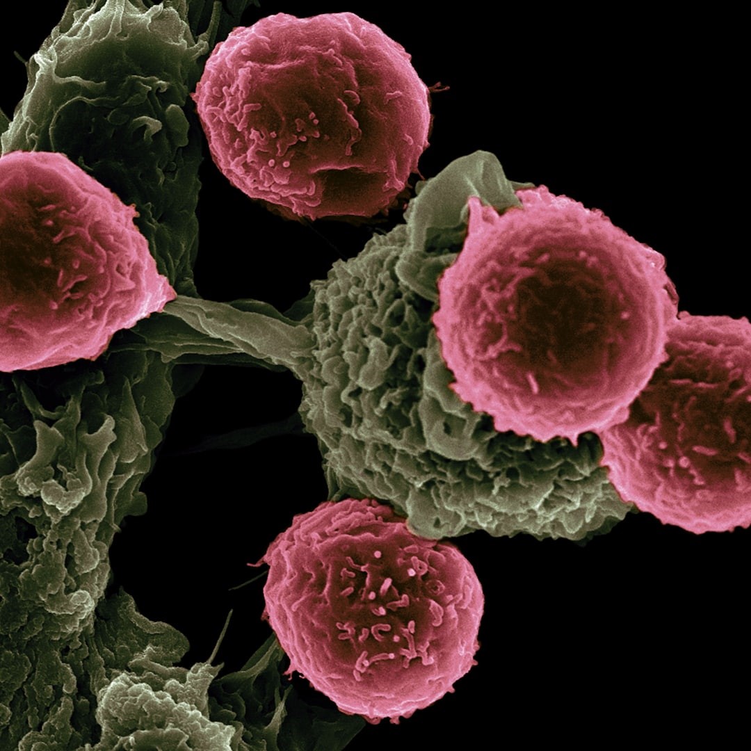 tmprss2-erg-fusion symboliseret ved nogle rosa og grå cellestrukturer, der er forbundet med strenge. Sort baggrund.