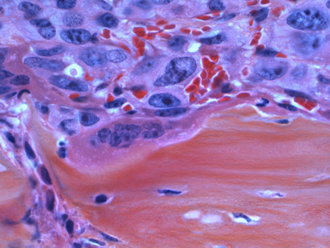 TP53-mutation symboliseret ved cellelag i blå og rosa farver.