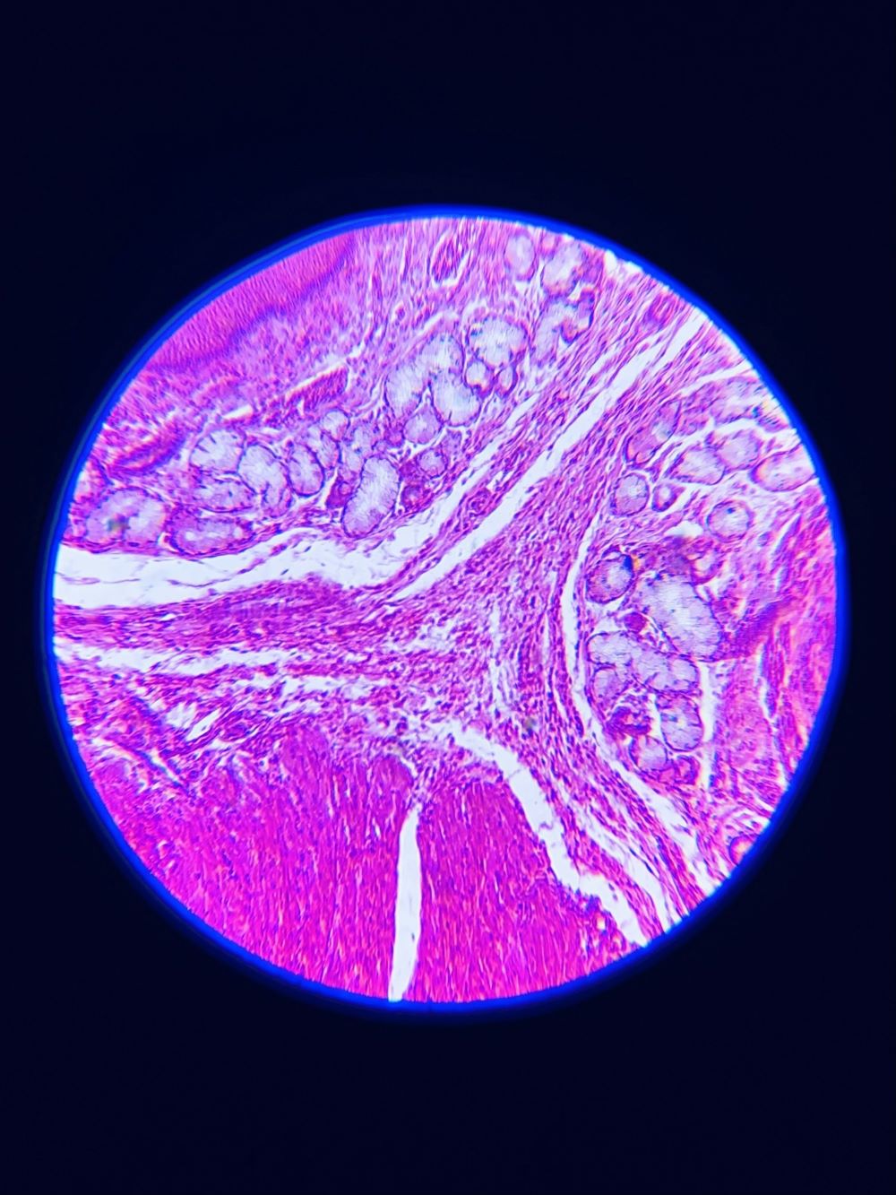 Biopsi ved kræft. Biopsi ved kræft, udsæd, finnålsaspiration, grovnålsbiopsi, incisionsbiopsi, excisionsbiopsi, knoglemarvsbiopsi, endoskopisk biopsi, bekræfte kræft, bestemme kræfttype, vurdere behandlingseffekt, undersøge vævsforandringer, invasiv procedure, risiko for komplikationer, prognose, overvågning.