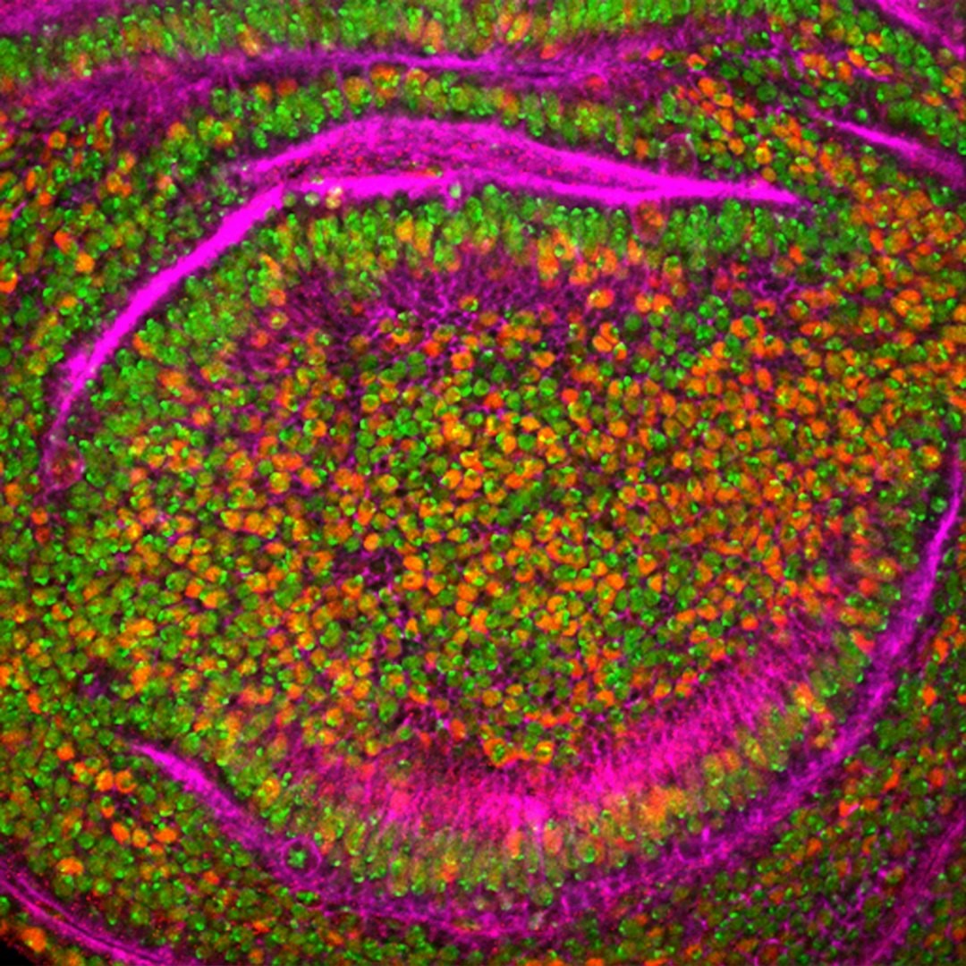 BRCA1 og BRCA2 – mutationer og kræft
