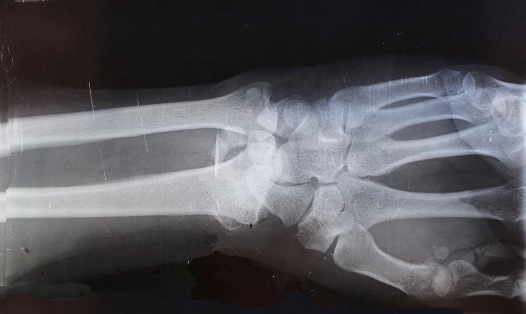 Knoglekræft symboliseret af røntgenbillede af del af underarm og det meste af hånden. Fokus på håndled.