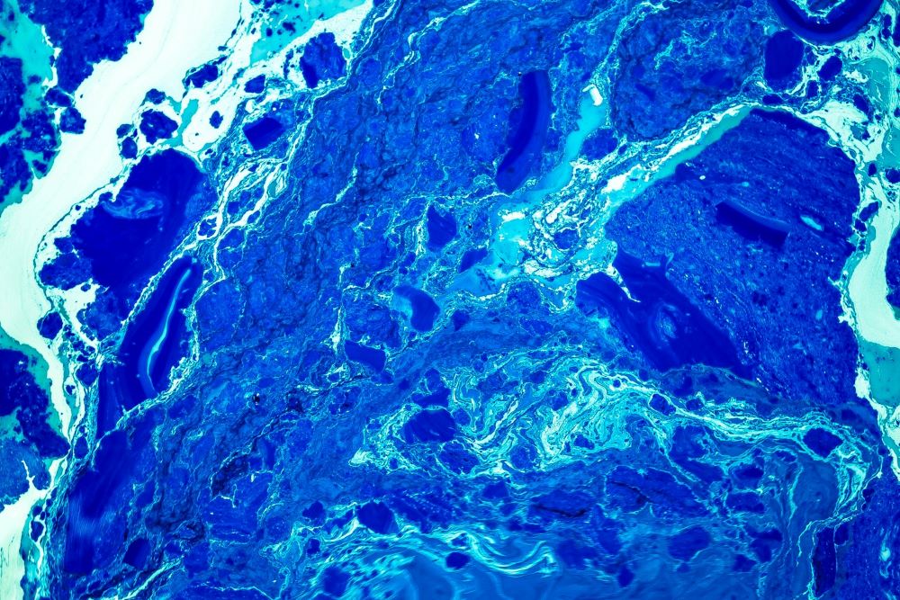 Ablationsbehandling symboliseret ved billede i blå nuancer af plastiske former.