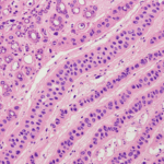 Brystkræft hos mænd symboliseret ved billede af kræftvæv i rosa og lilla farver, med hvidt ind imellem