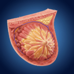 Brystkræft hos mænd symboliseret af model af bryst med frilagt væv i hudfarve med blå baggrund.