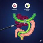 ERCP symboliseret ved billede af et tarmforløb med lever vist og stent, der lægges ind. Blå baggrund.