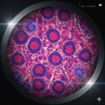 Kolorektal kræft symboliseret ved et foto af mikroskopiprøve i petriskål. Lilla celler med rød kerne.