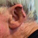 Ørekræft symboliseret ved et øre, hvor noget af det ydre øres brusk mangler.