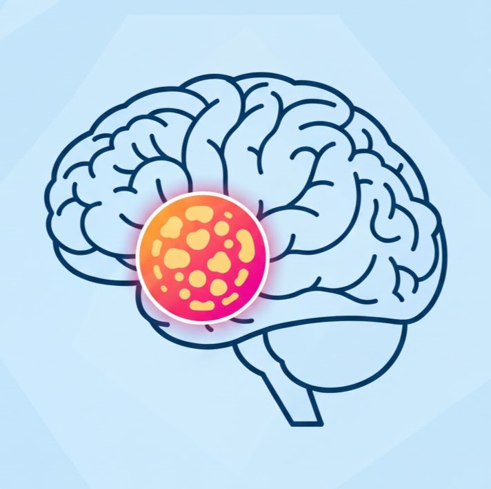 Oligodendrogliom symboliseret ved en stregtegning af en hjerne fra siden, med en rød plamage i midten.