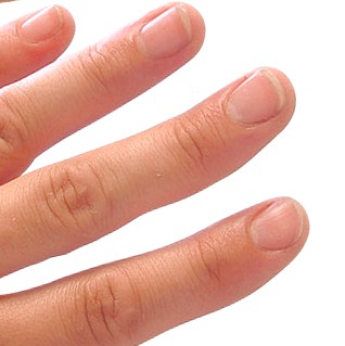 Subungualt Melanom symboliseret ved fingrene fra en hånd. Normale negle.