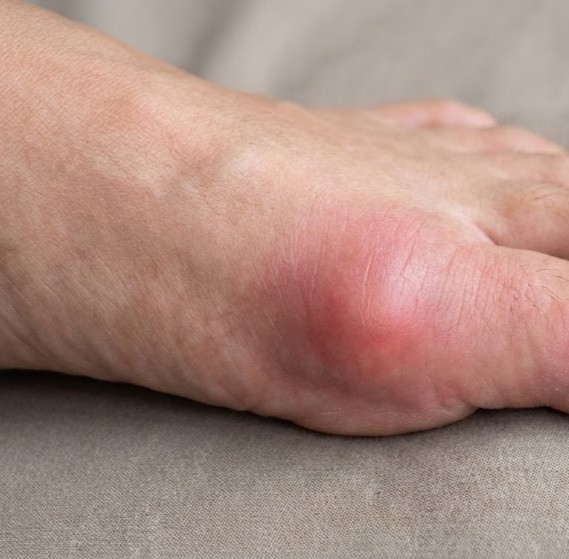 Stofskifte og koagulation symboliseret ved en fod, hvor storetås-leddet er hævet og rødt.