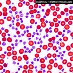 Essentiel Trombocytose symboliseret ved mikroskopibillede af blodlegemer - røde og lilla.